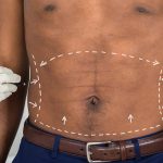 1140-abdominal-etching-esp