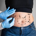 abdominoplastia-operacion